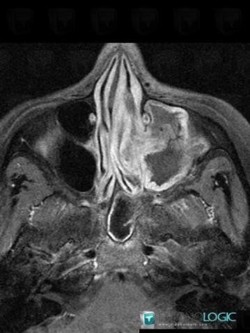 Aspergillosis, Sinus, MRI