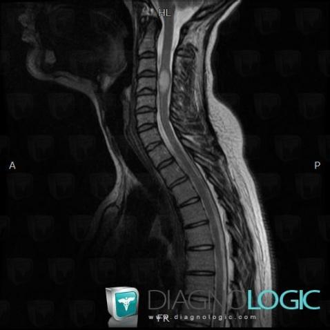 Astrocytoma, Spinal canal / Cord, MRI