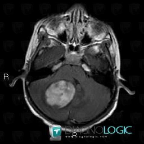 Astrocytome pilocytique, Fosse postérieure, IRM