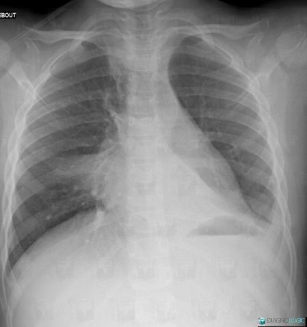 Atélectasie , Parenchyme pulmonaire, Radio