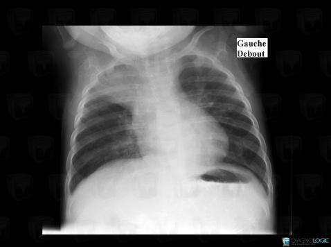 Atélectasie , Parenchyme pulmonaire, Radio