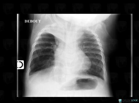 Atélectasie , Parenchyme pulmonaire, Radio