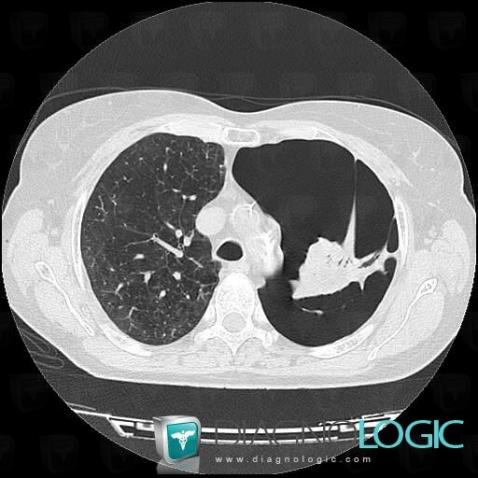 Atélectasie , Parenchyme pulmonaire, Scanner