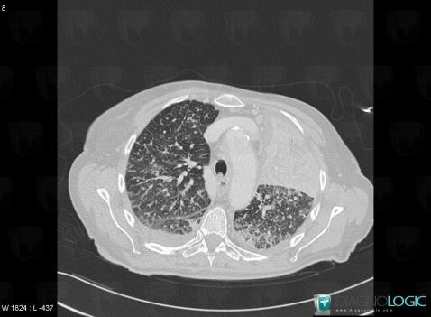 Atélectasie , Parenchyme pulmonaire, Scanner