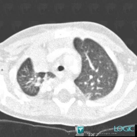 Atélectasie , Parenchyme pulmonaire, Scanner