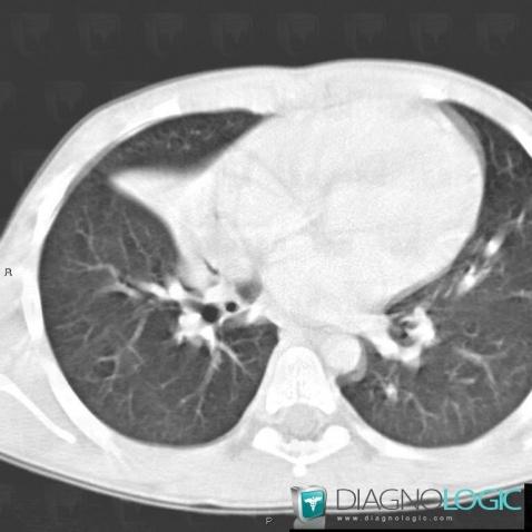 Atélectasie , Parenchyme pulmonaire, Scanner