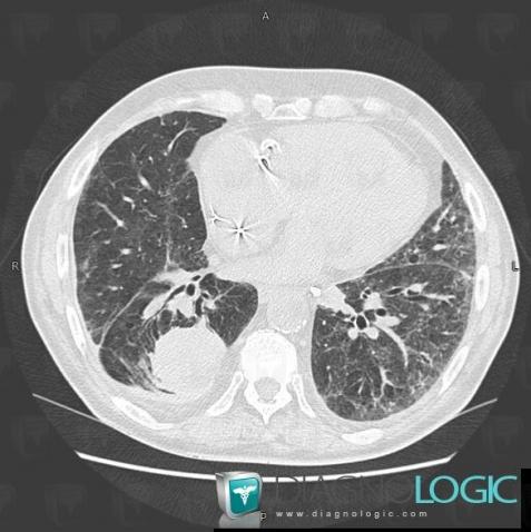 Atélectasie ronde, Parenchyme pulmonaire, Scanner