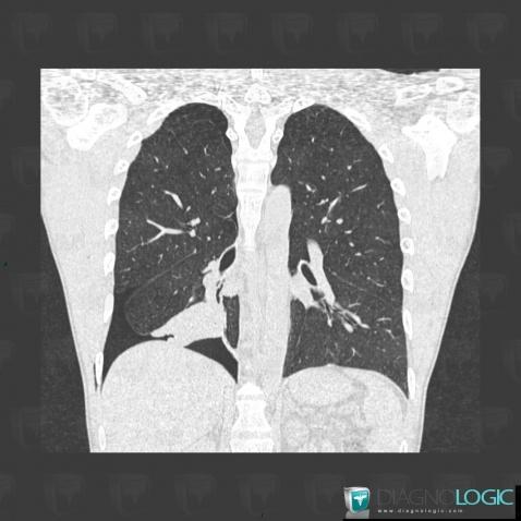 Atelectasis, Pulmonary parenchyma, CT