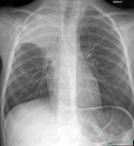 Atelectasis, Pulmonary parenchyma, X rays