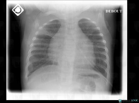 Atelectasis, Pulmonary parenchyma, X rays