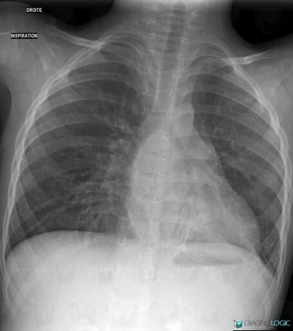 Radiology case : Atelectasis (X rays ,CT) - Diagnologic