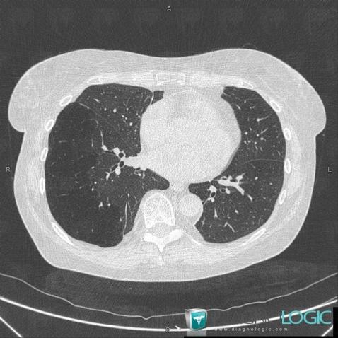 Atrésie bronchique, Parenchyme pulmonaire, Scanner