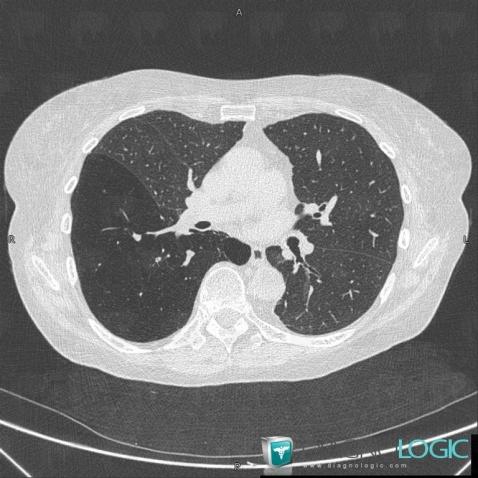 Atrésie bronchique, Parenchyme pulmonaire, Voies aériennes, Scanner