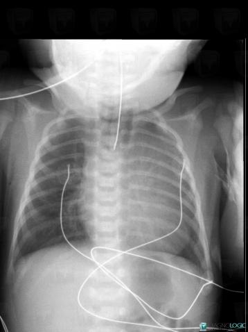 Atrésie-l'oesophage, Oesophage, Radio