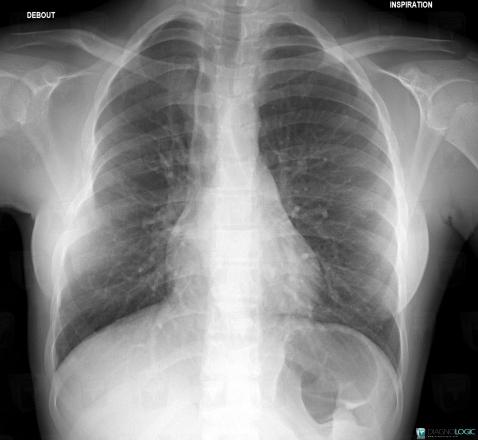 Atrésie-l'oesophage, Oesophage, Radio