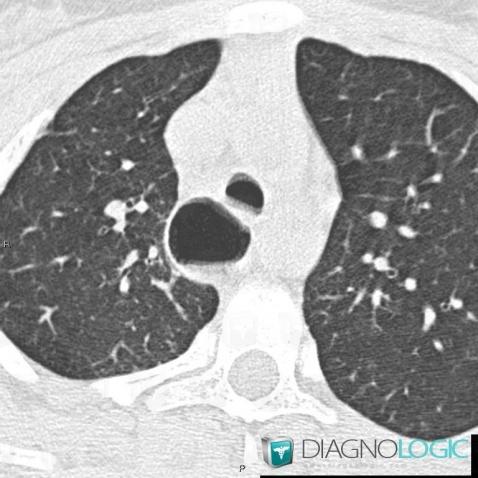 Atrésie-l'oesophage, Oesophage, Scanner