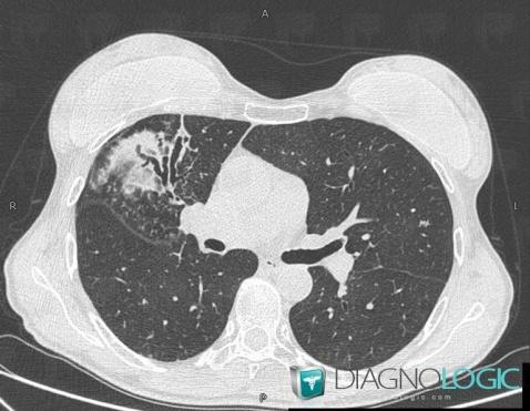 Atypical mycobacterial infection, Airways, CT