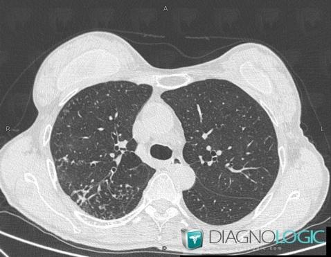 Atypical mycobacterial infection, Pulmonary parenchyma, CT