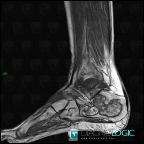 Avascular necrosis, Calcaneus, MRI