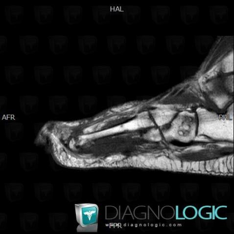 Avascular necrosis, Cuboid, MRI