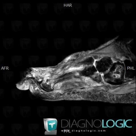 Avascular necrosis, Cuboid, MRI