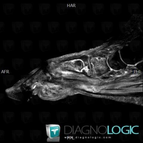 Avascular necrosis, Cuneiforms bones, MRI