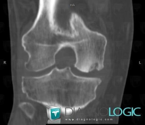 Avascular necrosis, Femur - Distal part, CT