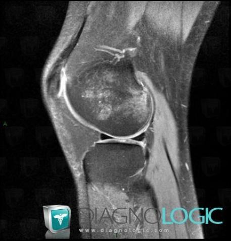 Avascular necrosis, Femur - Distal part, MRI