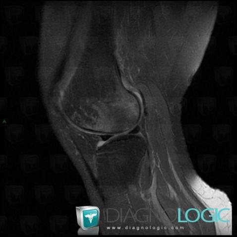 Avascular necrosis, Femur - Distal part, MRI