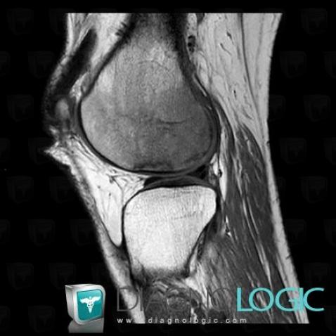 Avascular necrosis, Femur - Distal part, MRI