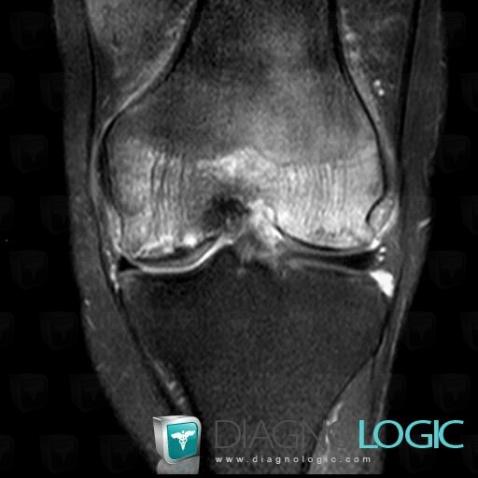 Avascular necrosis, Femur - Distal part, MRI