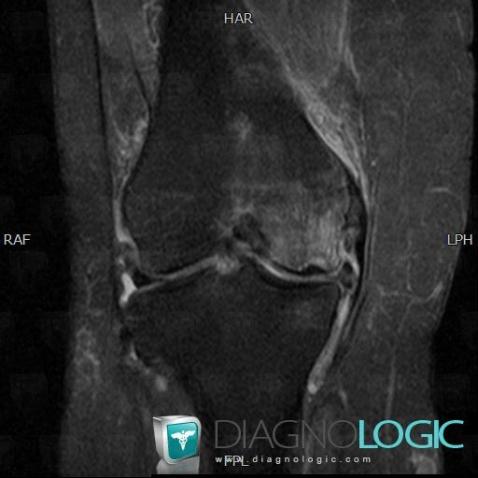 Avascular necrosis, Femur - Distal part, MRI