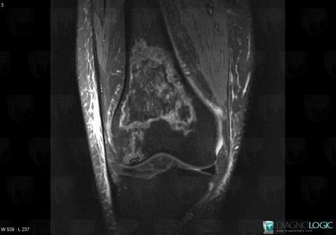 Avascular necrosis, Femur - Distal part, MRI