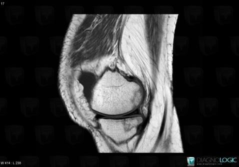 Avascular necrosis, Femur - Distal part, Tibia - Proximal part, MRI