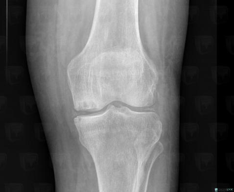 Avascular necrosis, Femur - Distal part, X rays