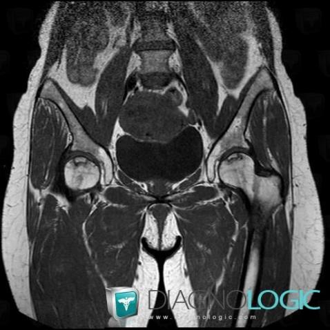 Avascular necrosis, Femur - Proximal part, MRI