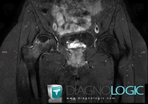 Avascular necrosis, Femur - Proximal part, MRI