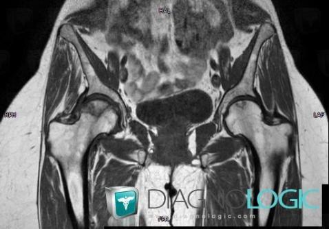 Avascular necrosis, Femur - Proximal part, MRI