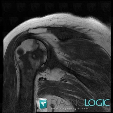 Avascular necrosis, Humerus - Proximal part, MRI