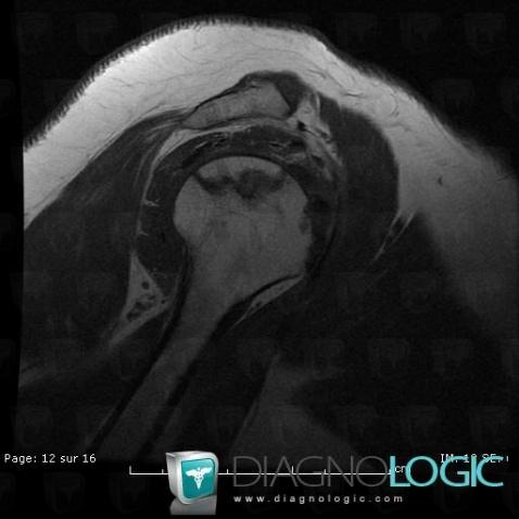 Avascular necrosis, Humerus - Proximal part, MRI