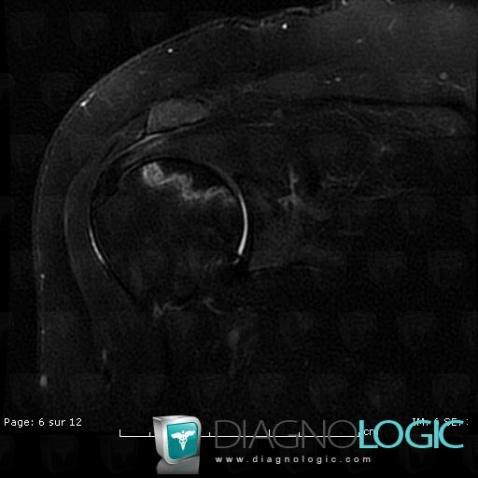 Avascular necrosis, Humerus - Proximal part, MRI