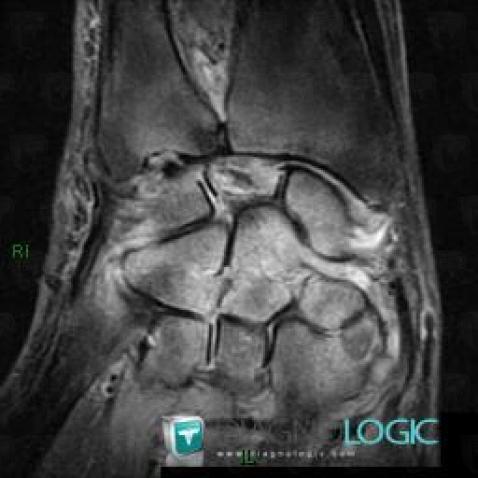 Avascular necrosis, Lunate, MRI