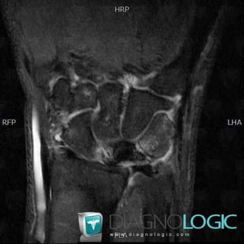 Avascular necrosis, Lunate, MRI