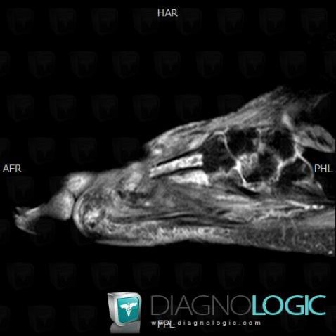 Avascular necrosis, Metatarsal bones, MRI