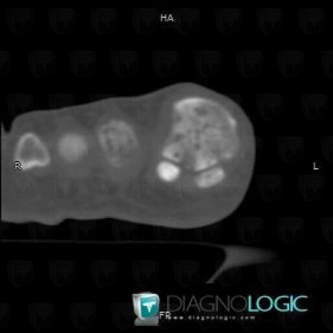 Avascular necrosis, Phalanx / Sesamoid bones - Foot, CT