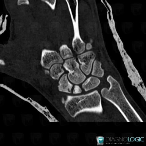 Avascular necrosis, Scaphoid, CT