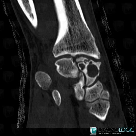 Avascular necrosis, Scaphoid, CT