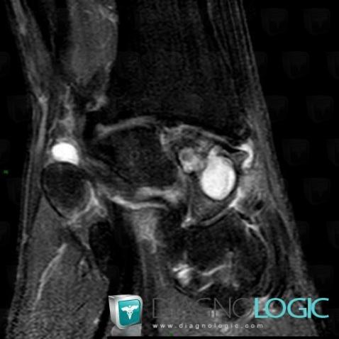 Avascular necrosis, Scaphoid, MRI