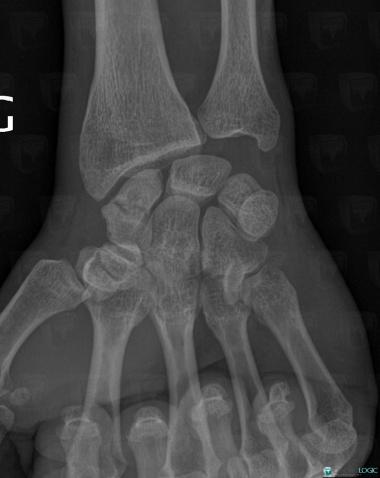 Avascular necrosis, Scaphoid, X rays