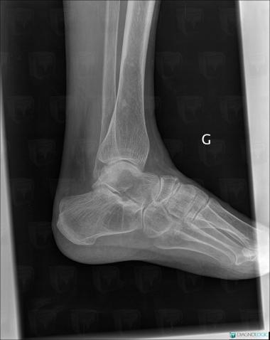 Avascular necrosis, Talus, Calcaneus, X rays